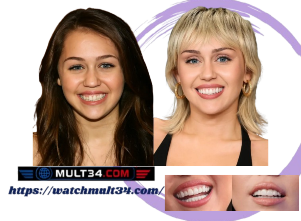 Miley Cyrus Veneers: Inside Her Stunning Smile Transformation Miley Cyrus Veneers